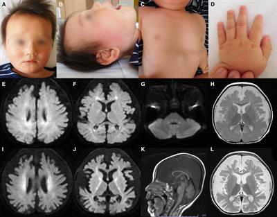 Case Report: Novel compound heterozygous TPRKB variants cause Galloway-Mowat syndrome